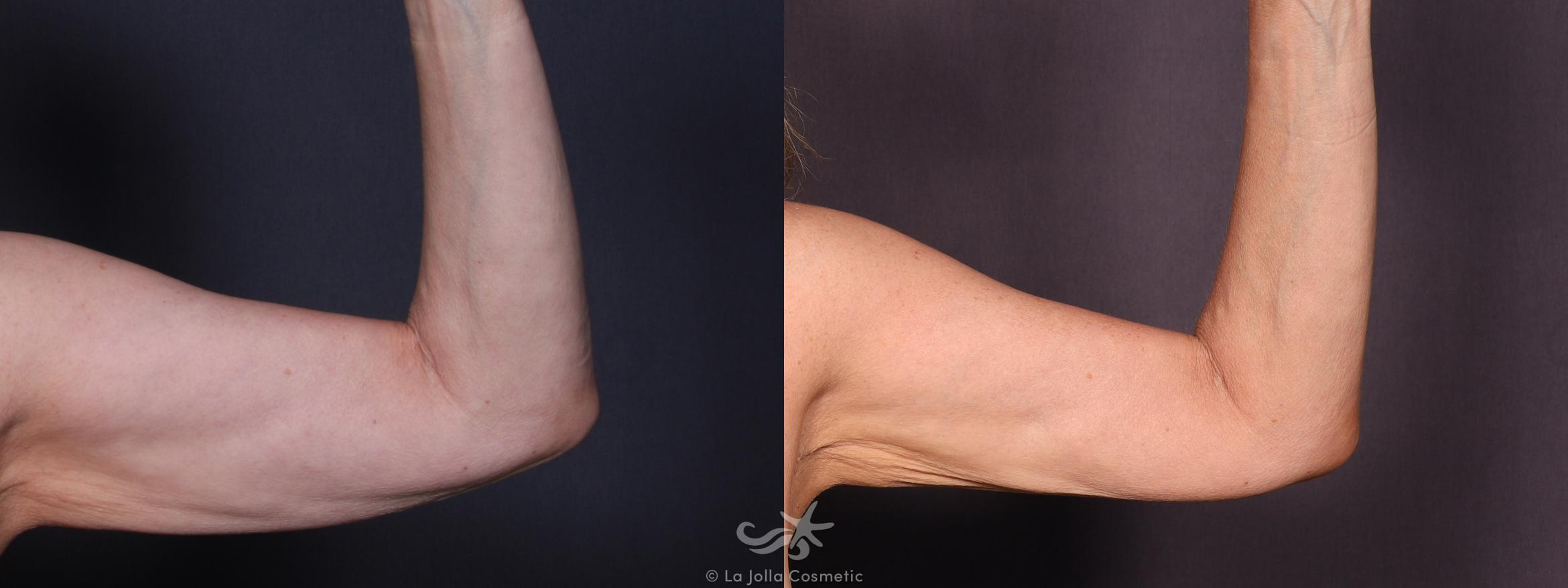 Before & After Liposuction Result 703 Left Side View in San Diego, CA