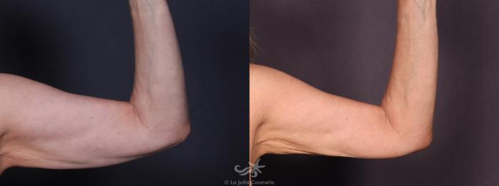 Before & After Liposuction Result 703 Left Side View in San Diego, Carlsbad, CA