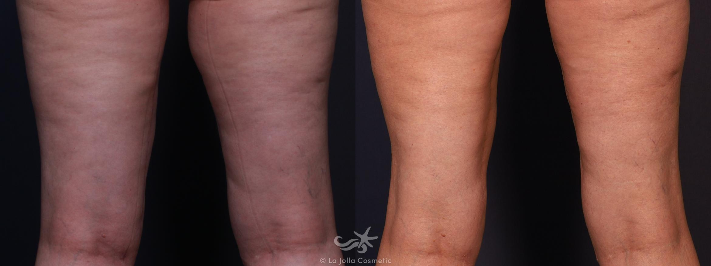 Before & After Liposuction Result 704 Back View in San Diego, CA
