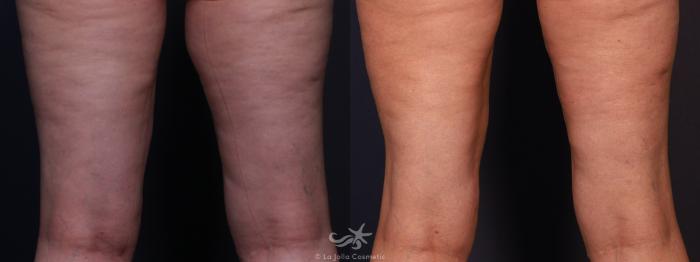 Before & After Liposuction Result 704 Back View in San Diego, Carlsbad, CA