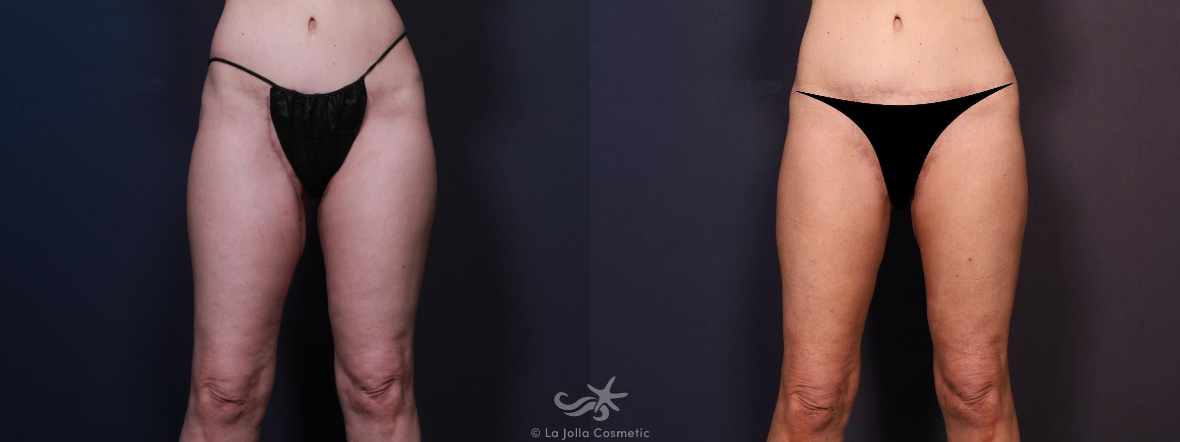 Before & After Liposuction Result 704 Front View in San Diego, CA