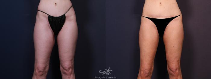 Before & After Liposuction Result 704 Front View in San Diego, Carlsbad, CA
