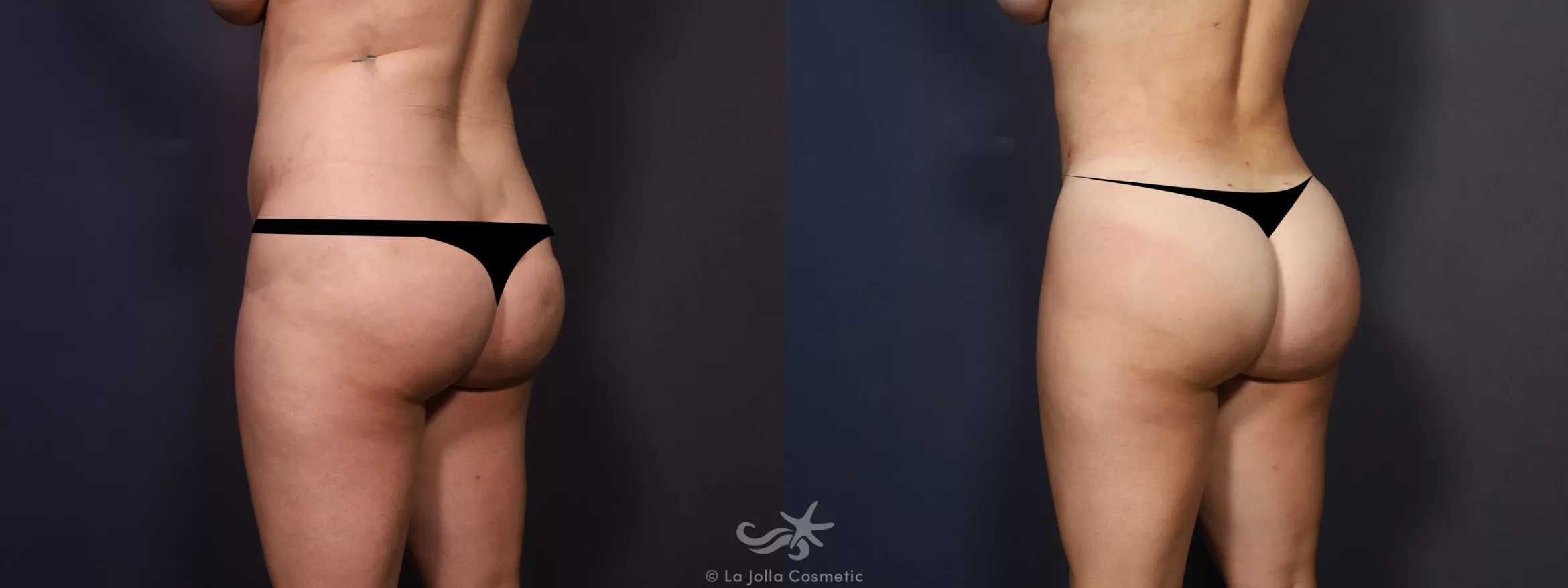 Before & After Liposuction Result 726 Back Left  View in San Diego, CA
