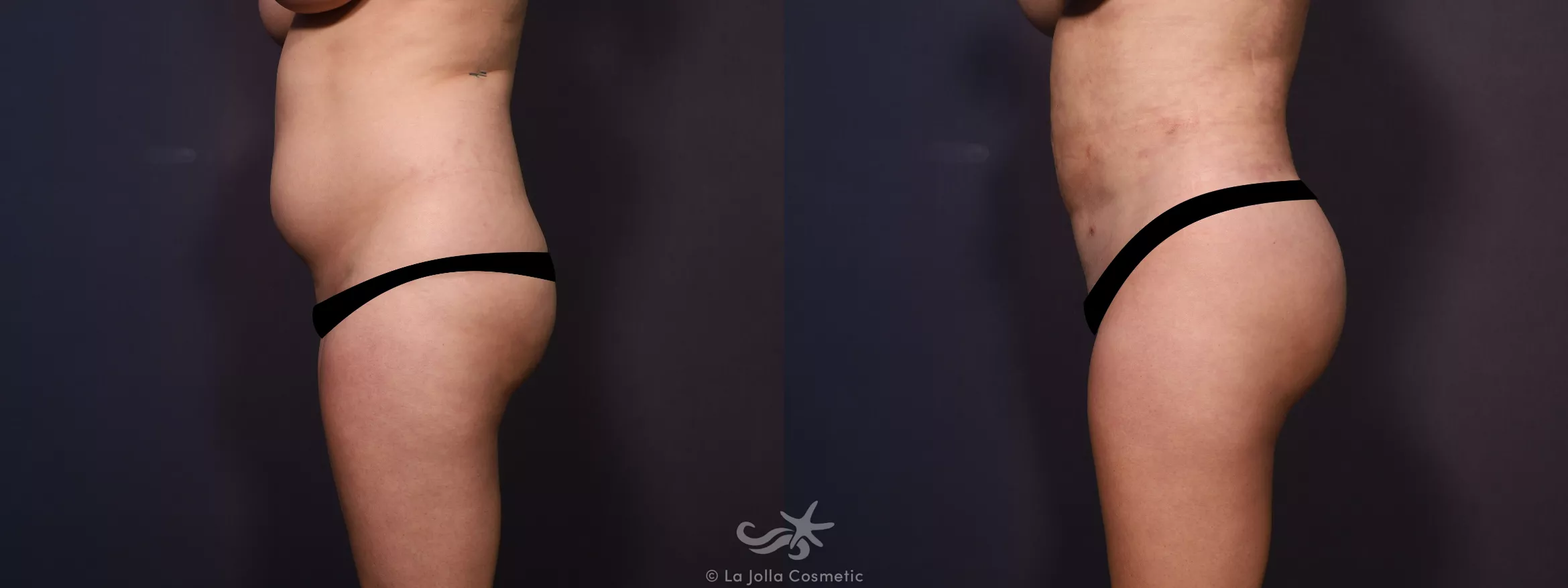 Before & After Liposuction Result 726 Left Side View in San Diego, CA