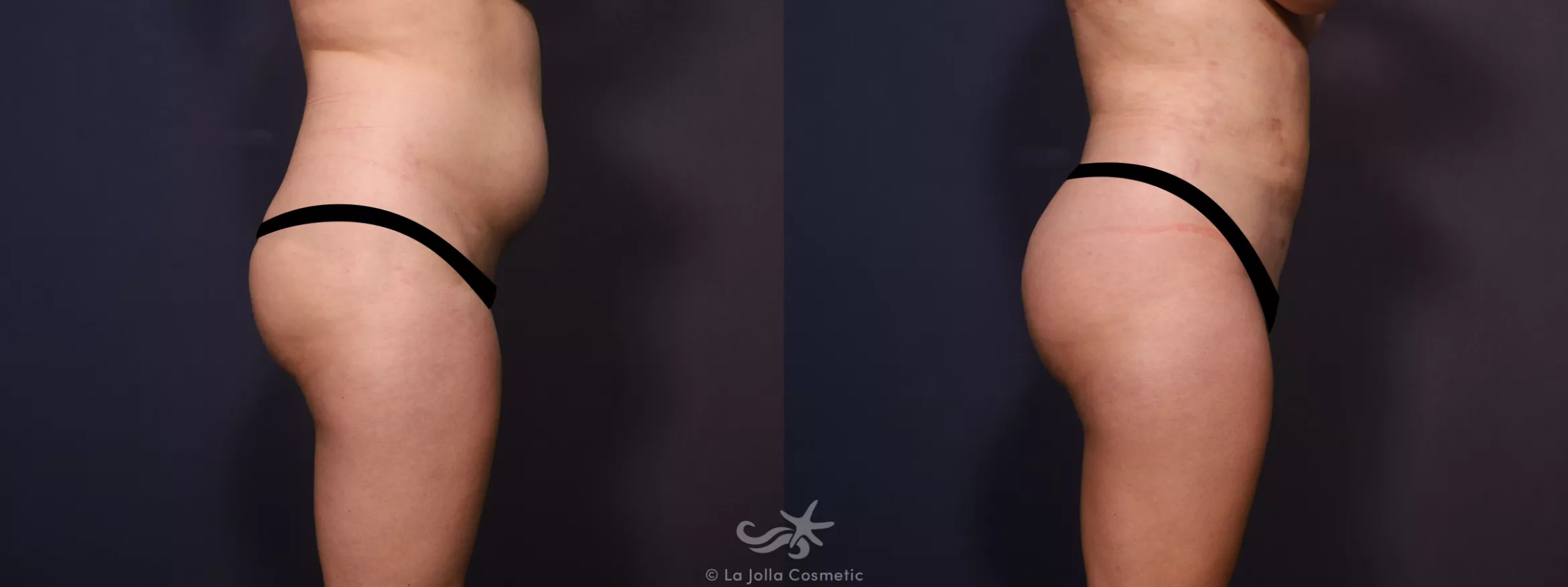 Before & After Liposuction Result 726 Right Side View in San Diego, CA