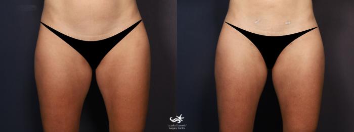 Liposuction Before and After Photo Gallery, San Diego, CA