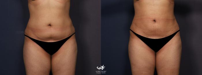 lipo c shot before and after Liposuction Photo Gallery | San Diego, CA Size:5Kg Nutrion L-Glutathione 1000mg Tablets –