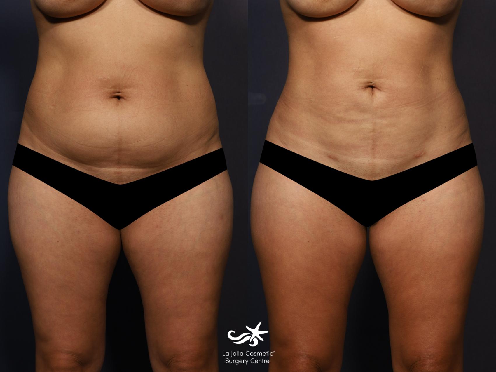 Liposuction Before and After Pictures Result 955