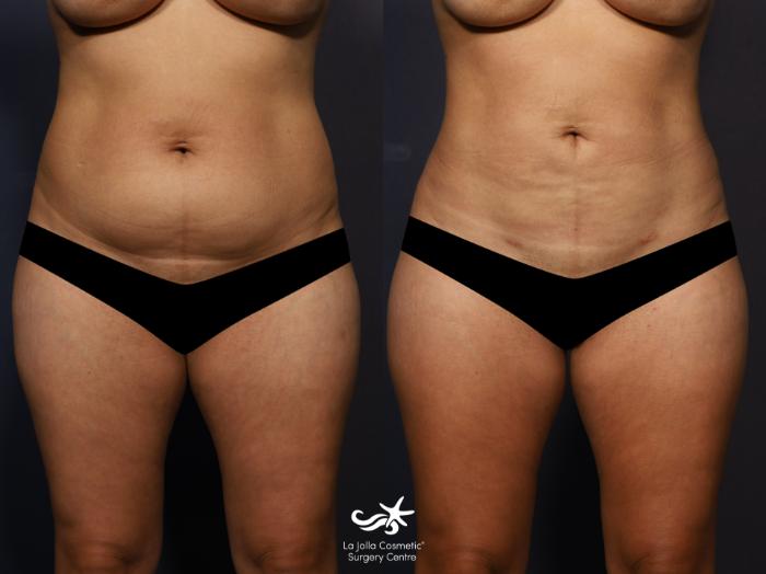 lipo after c-section before and after Liposuction Before and After Photo Gallery | San Diego, CA