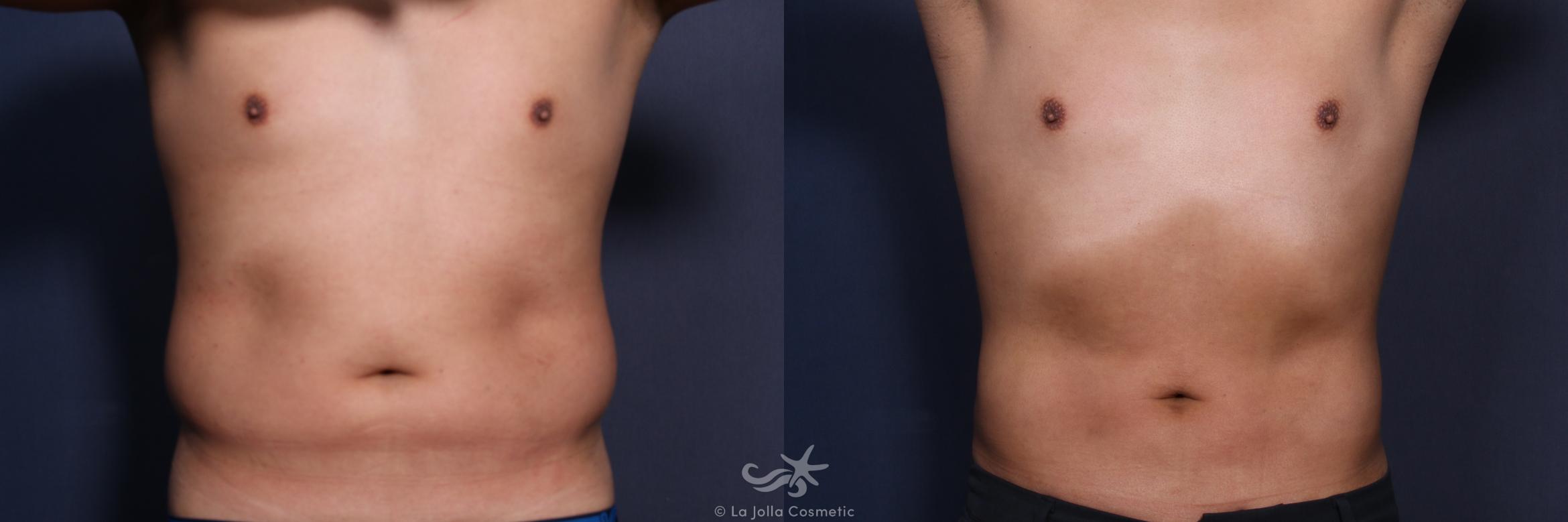 Before & After Male Liposuction Result 147 Front View in San Diego, CA