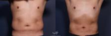 Before & After Male Liposuction Result 147 Front View in San Diego, Carlsbad, CA