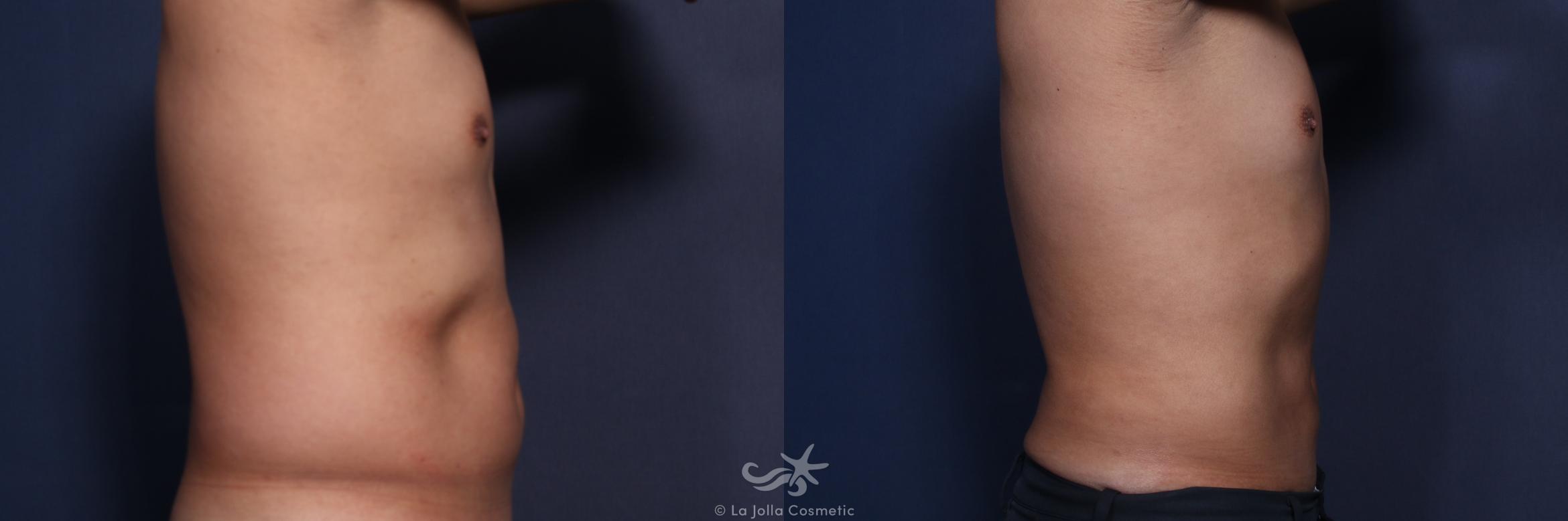 Before & After Male Liposuction Result 147 Right Side View in San Diego, CA