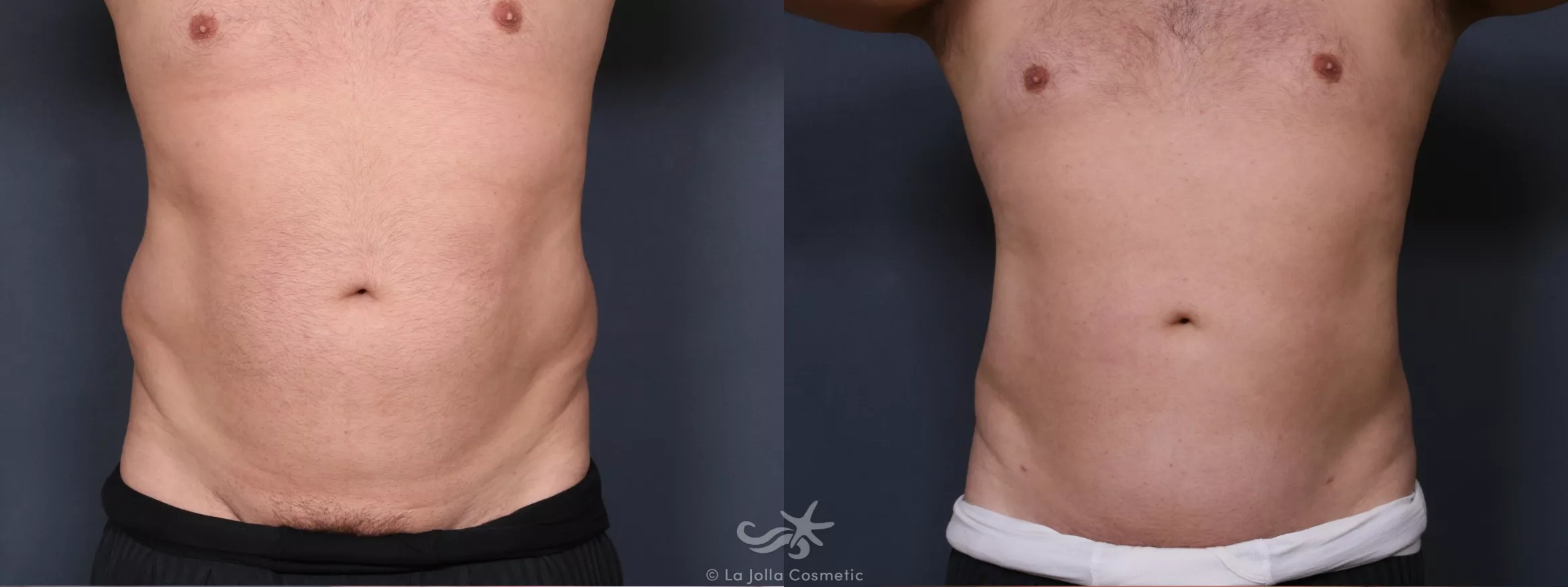Before & After Male Liposuction Result 417 Front View in San Diego, CA