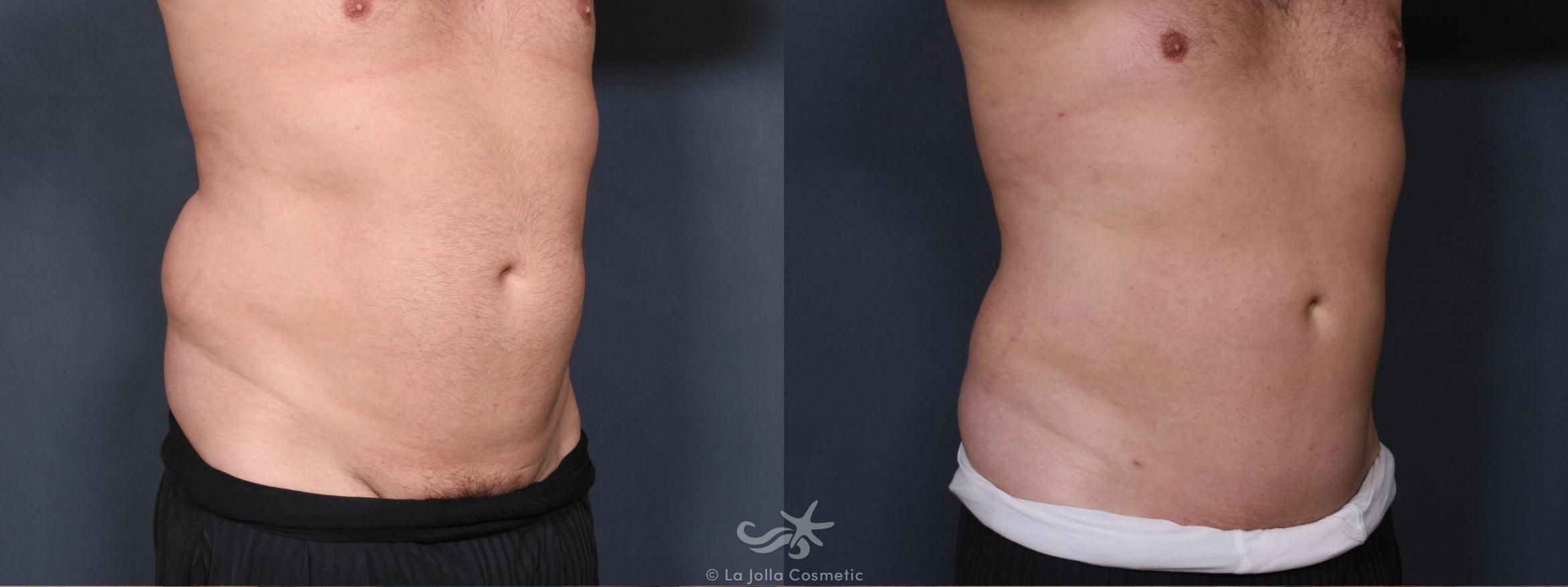Before & After Male Liposuction Result 417 Right Oblique View in San Diego, CA
