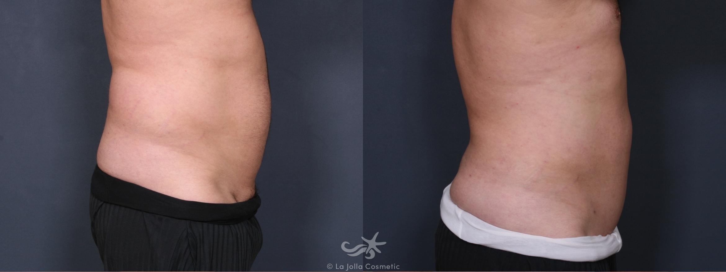 Before & After Male Liposuction Result 417 Right Side View in San Diego, CA