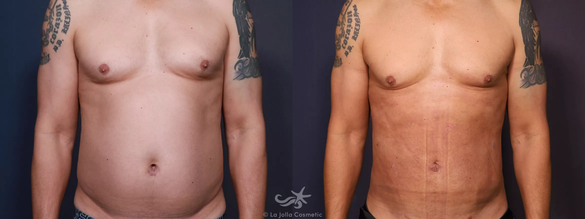 Before & After Male Liposuction Result 671 Front View in San Diego, CA