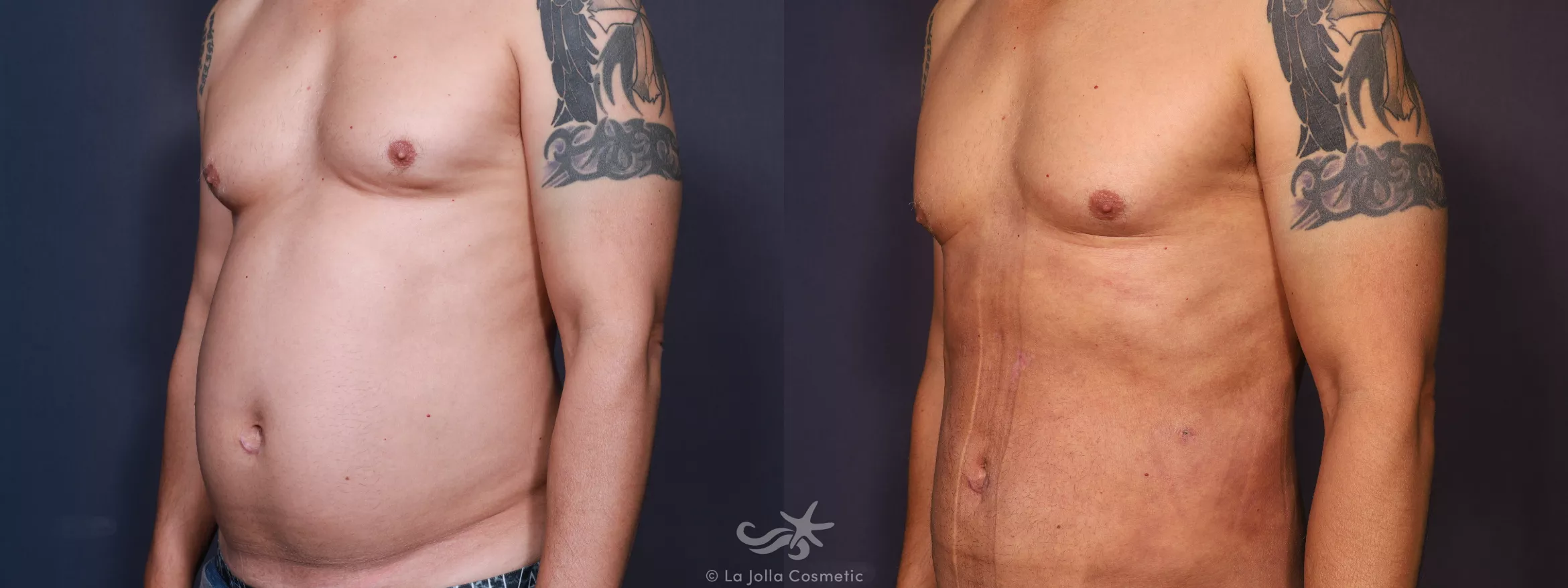 Before & After Male Liposuction Result 671 Left Oblique View in San Diego, CA