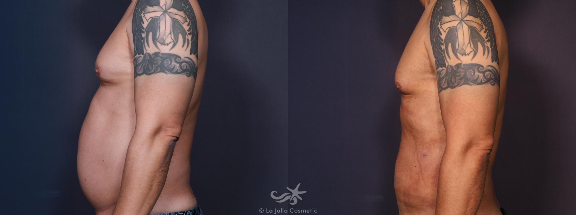 Before & After Male Liposuction Result 671 Left Side View in San Diego, CA