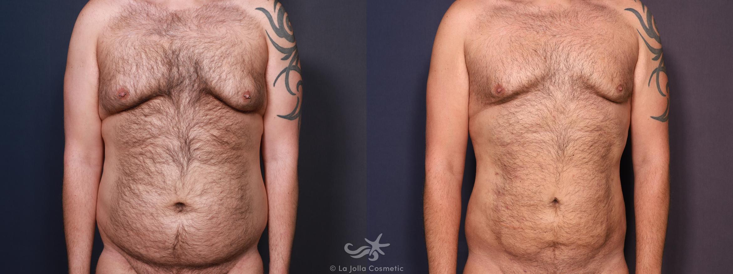 Before & After Male Liposuction Result 672 Front View in San Diego, CA
