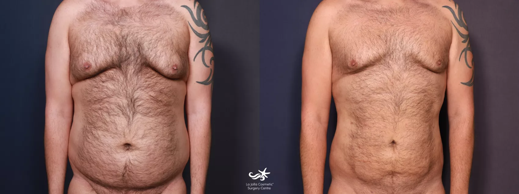 Male Liposuction Before and After