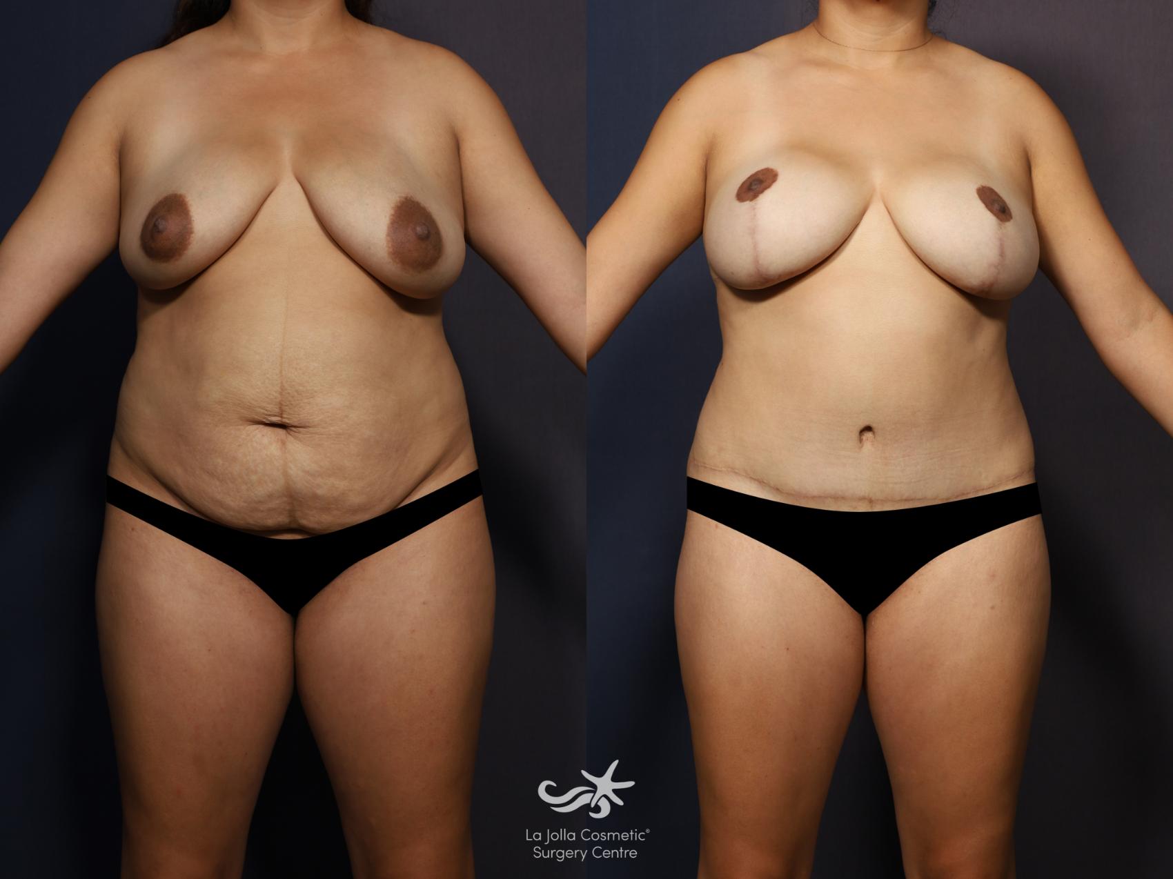Before & After Mommy Makeover Result 1165 Front View in San Diego, CA