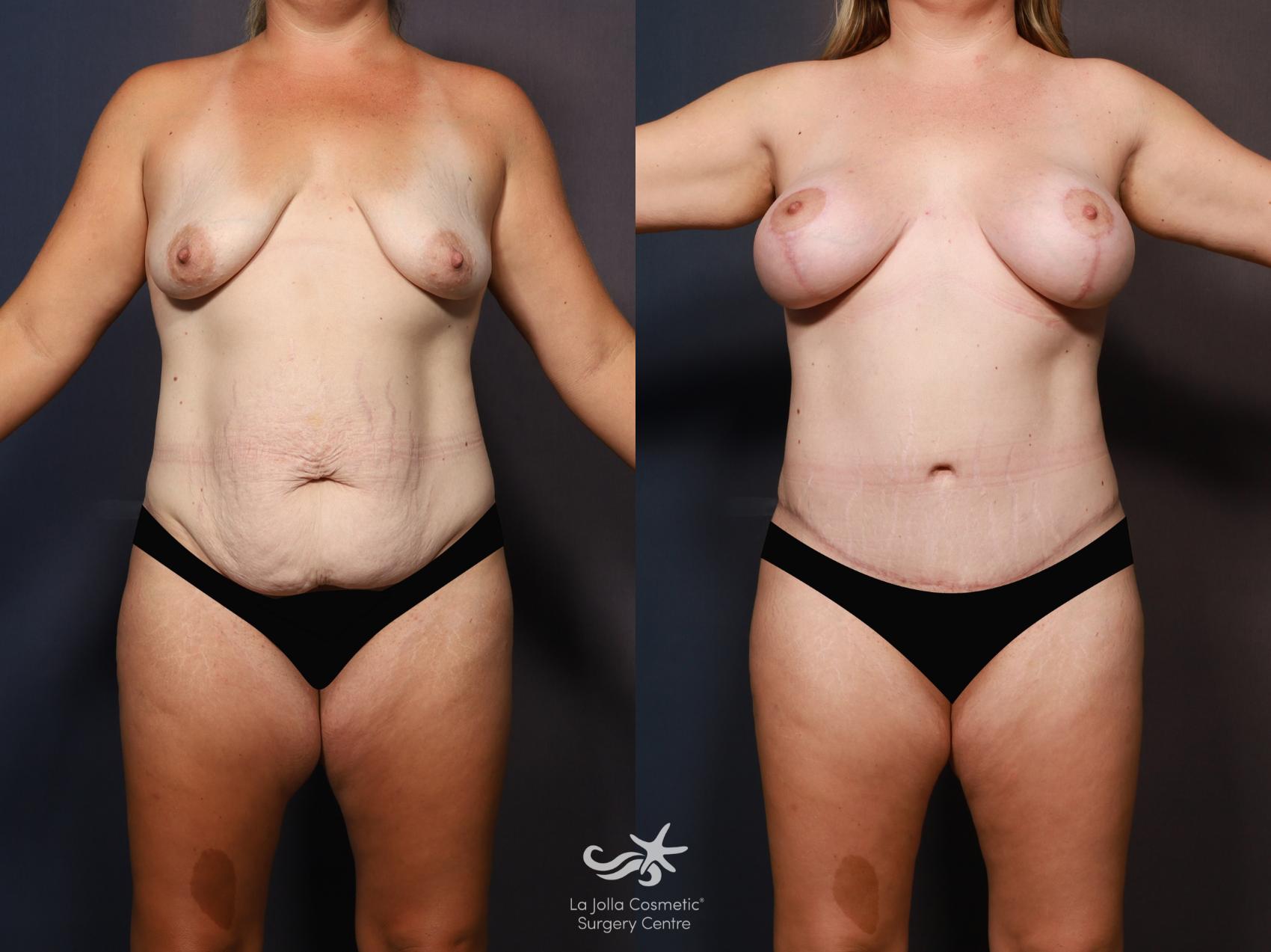 Before & After Mommy Makeover Result 1266 Front View in San Diego, CA