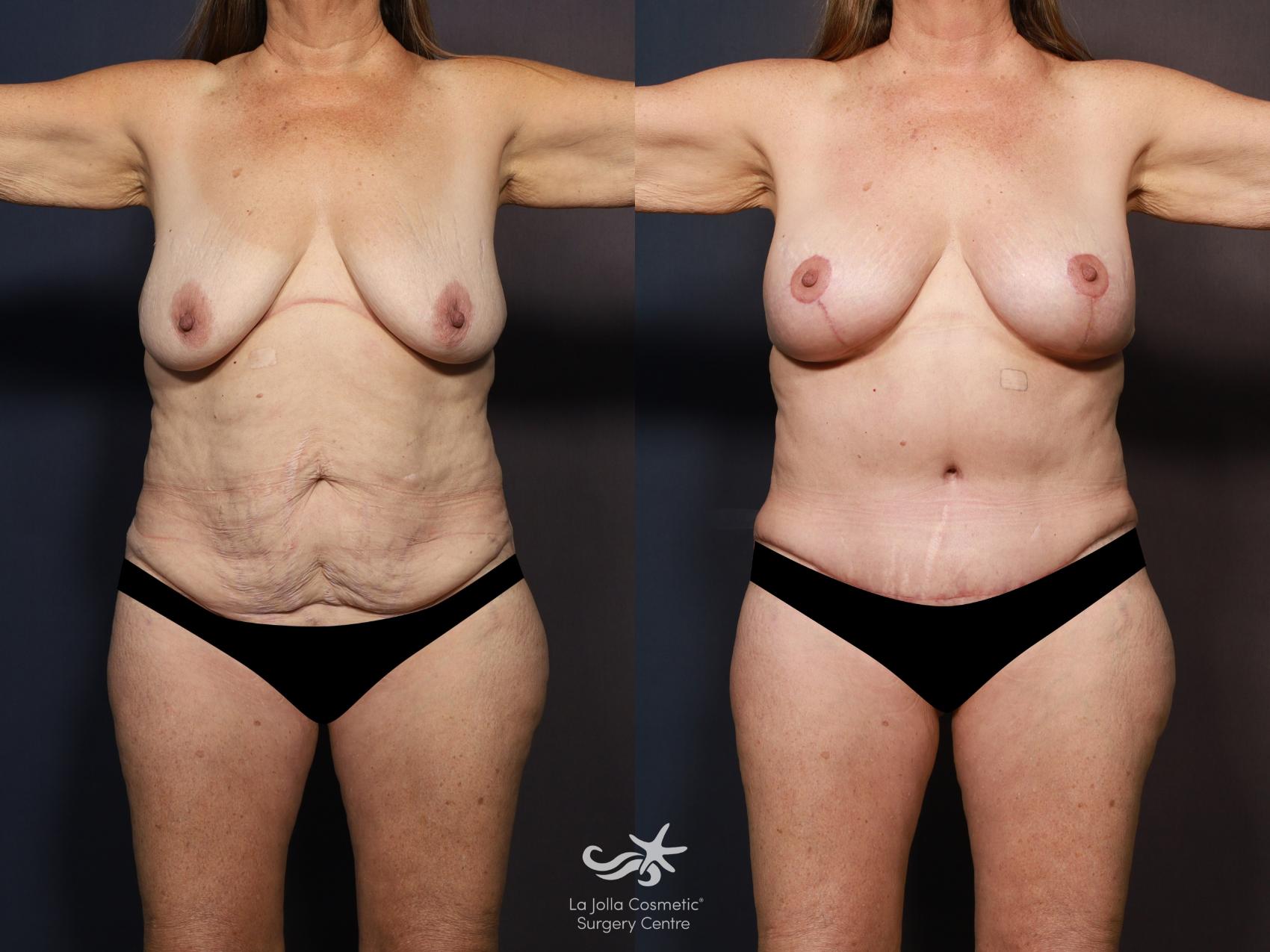 Before & After Mommy Makeover Result 1348 Front View in San Diego, CA