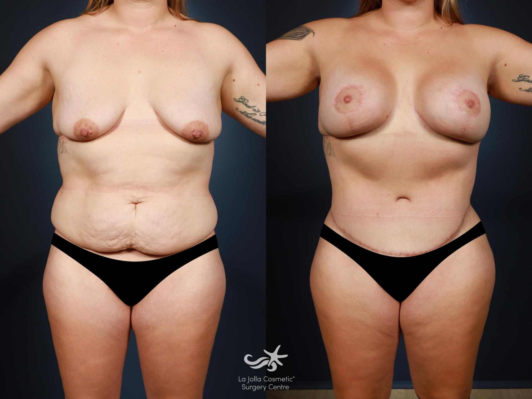 Before & After Mommy Makeover Result 1423 Front View in San Diego, CA