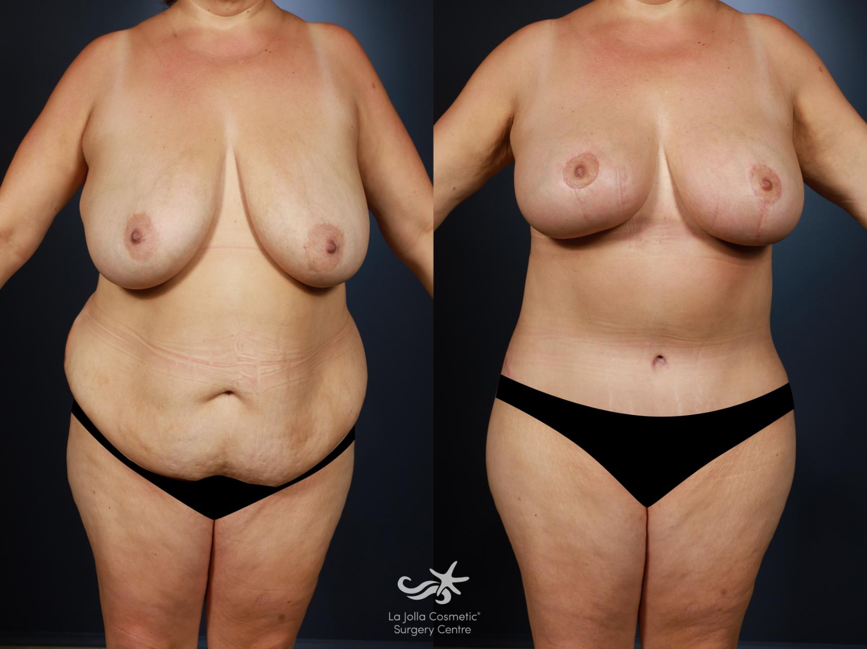 Before & After Mommy Makeover Result 1452 Front View in San Diego, CA