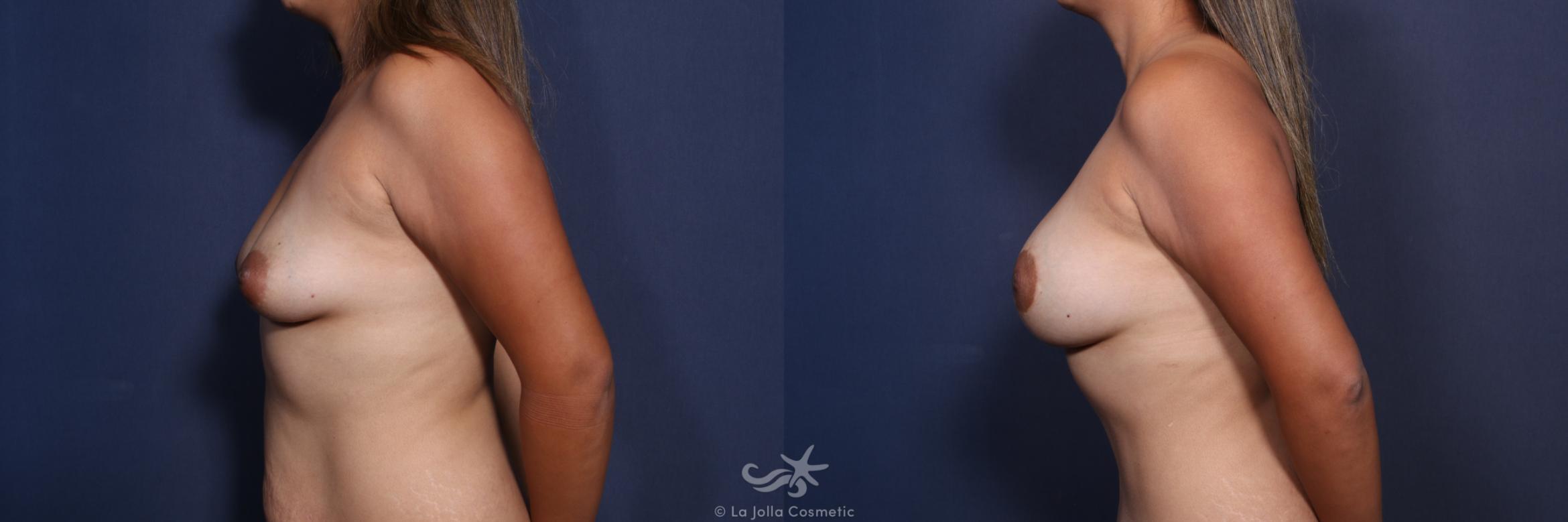 Before & After Breast Augmentation Result 592 Left Side View in San Diego, CA