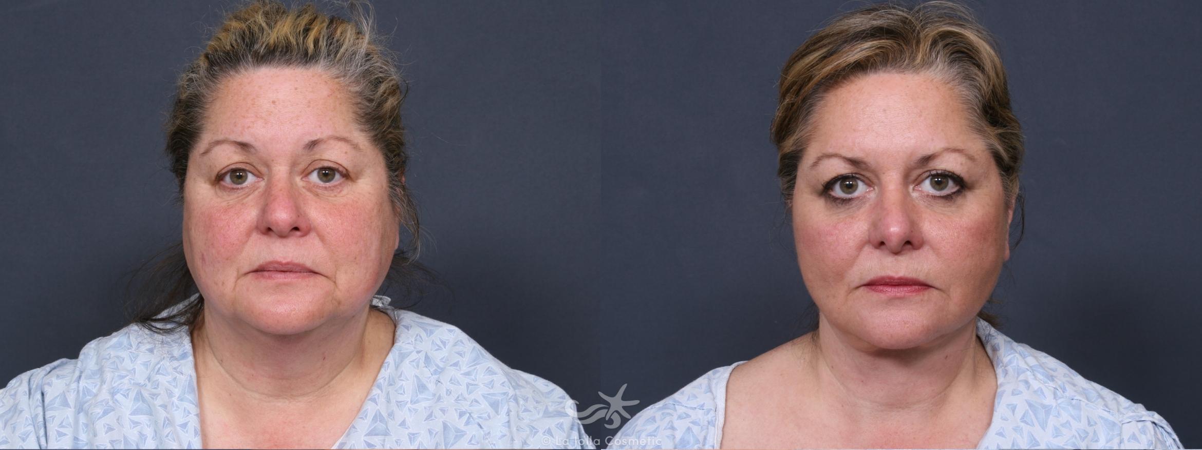 Before & After Neck Lift Result 380 Front View in San Diego, CA