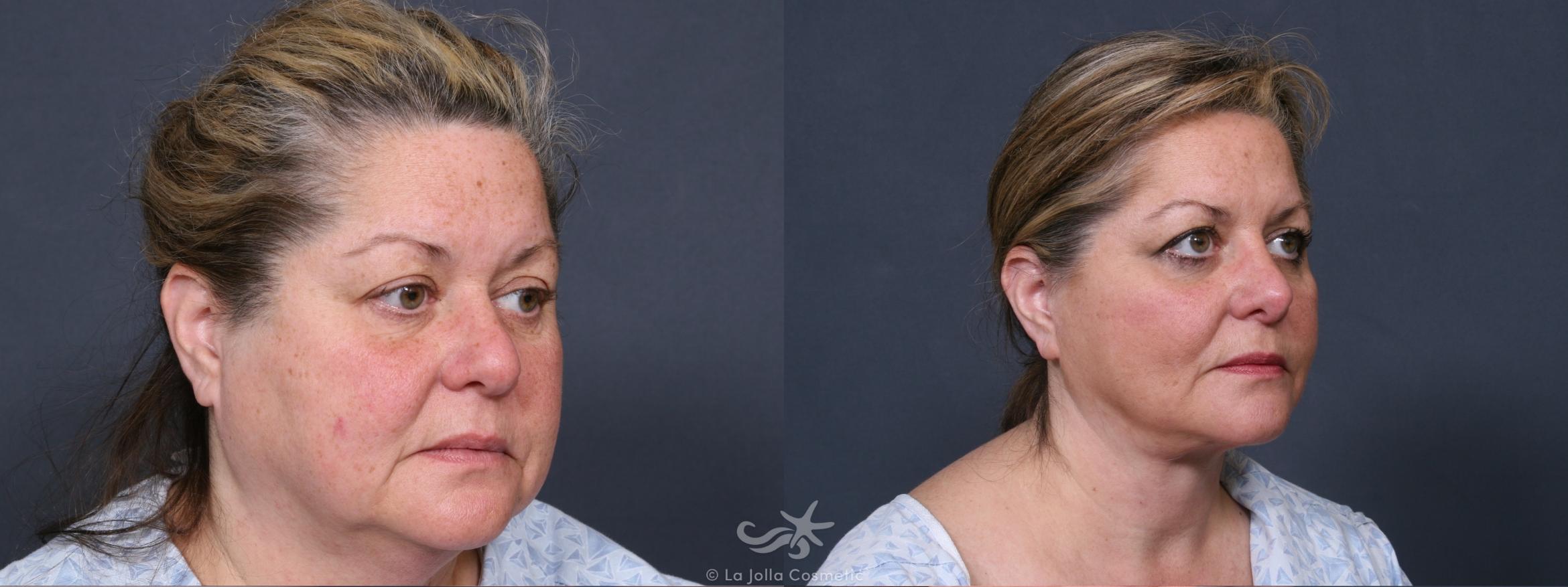 Before & After Neck Lift Result 380 Right Oblique View in San Diego, CA