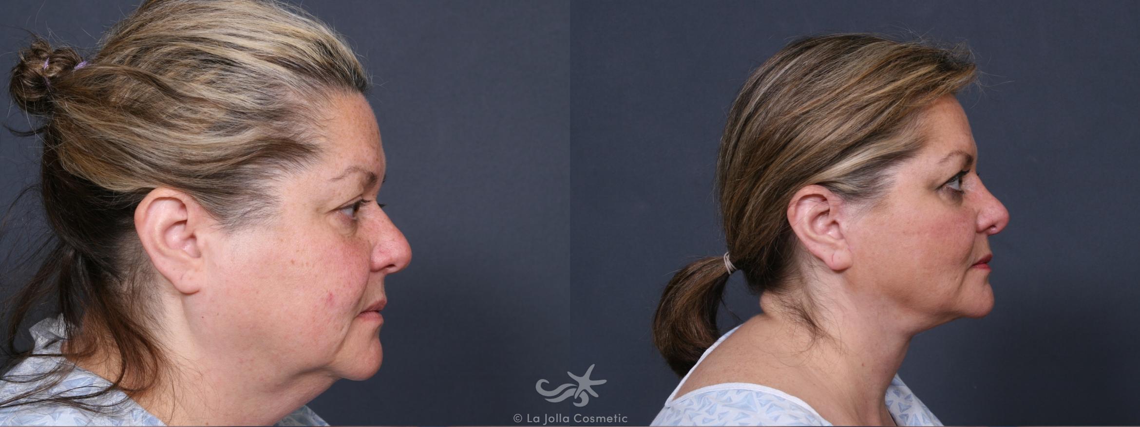 Before & After Neck Lift Result 380 Right Side View in San Diego, CA