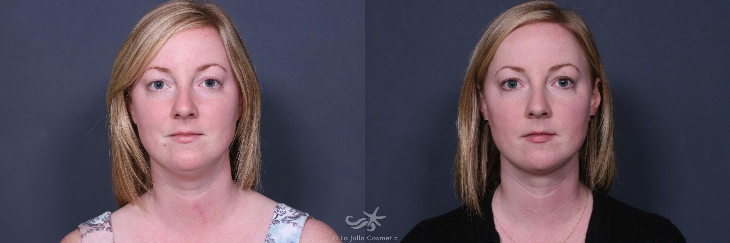 Before & After Neck Lift Result 495 Front View in San Diego, CA