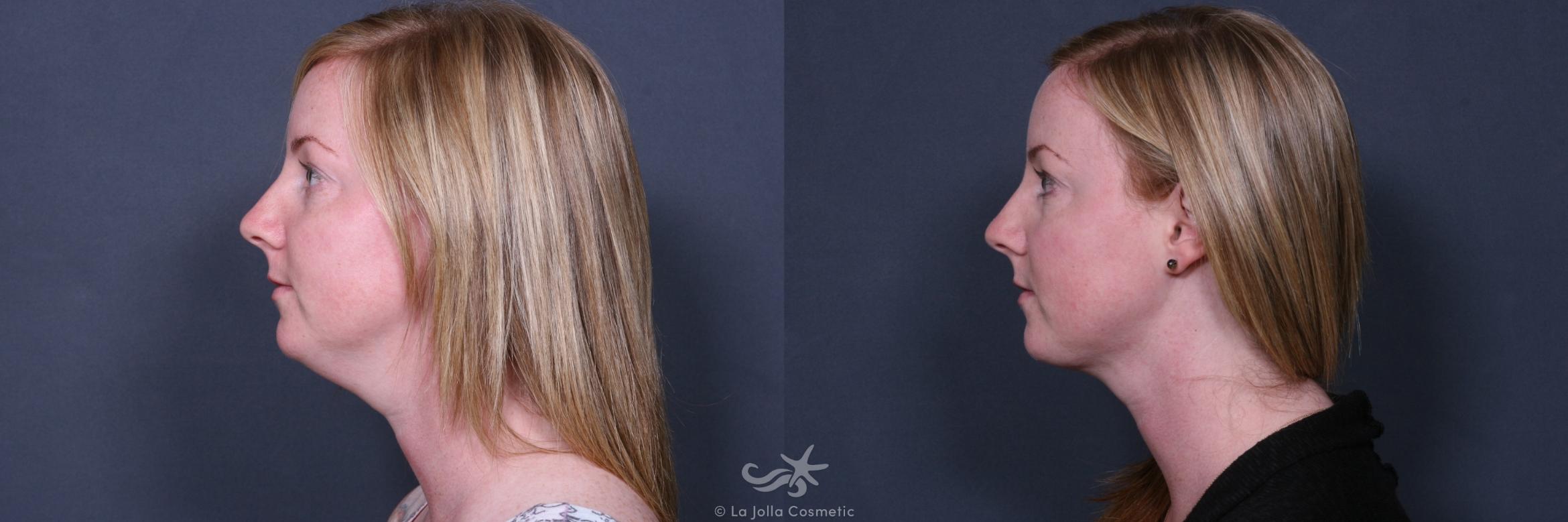 Before & After Neck Lift Result 495 Left Side View in San Diego, CA