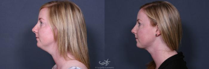 Before & After Neck Lift Result 495 Left Side View in San Diego, Carlsbad, CA
