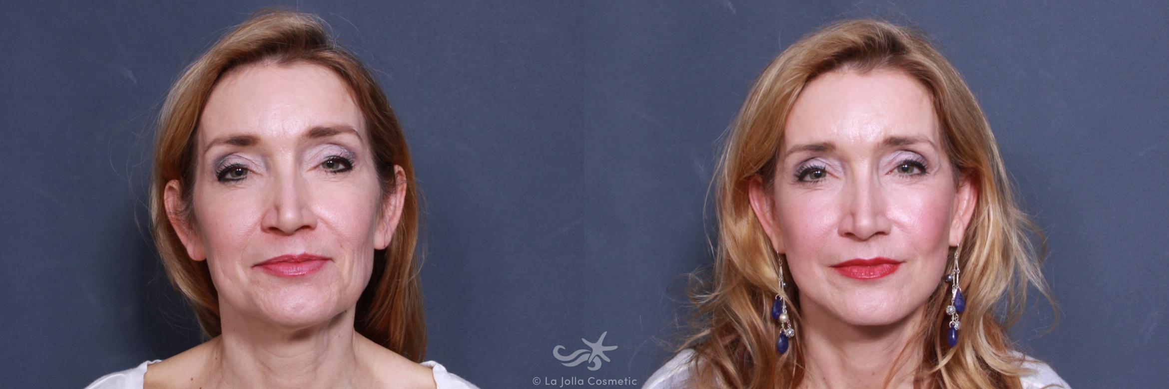 Before & After Neck Lift Result 575 Front View in San Diego, CA