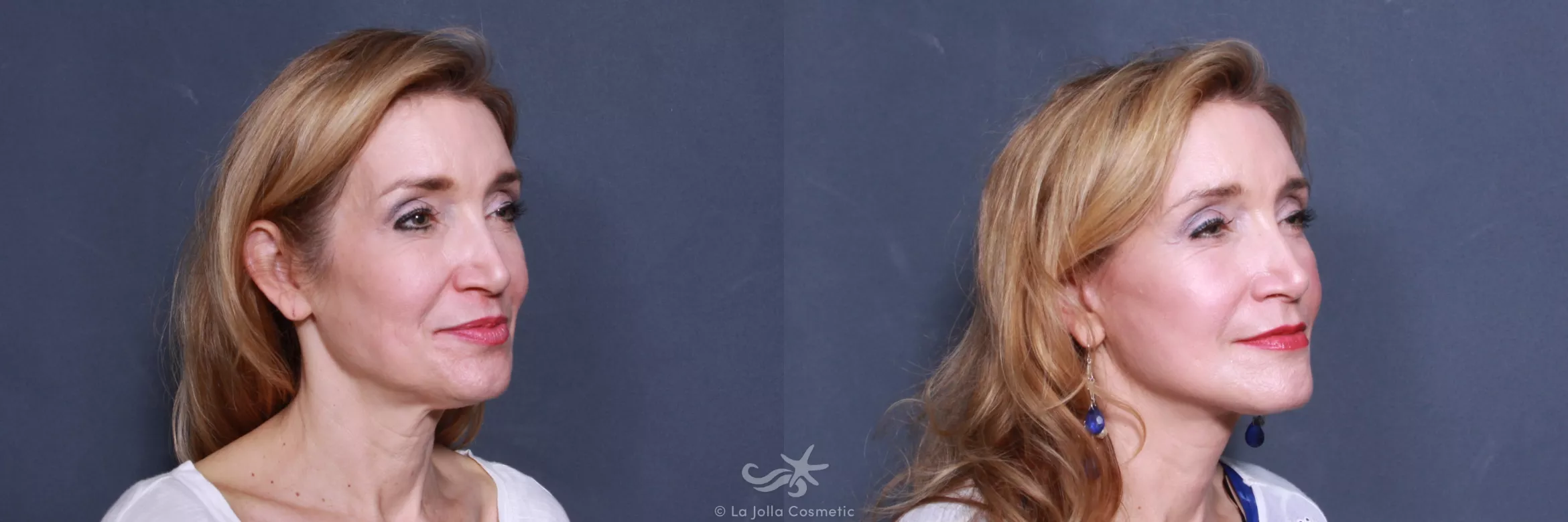Before & After Neck Lift Result 575 Right Oblique View in San Diego, CA