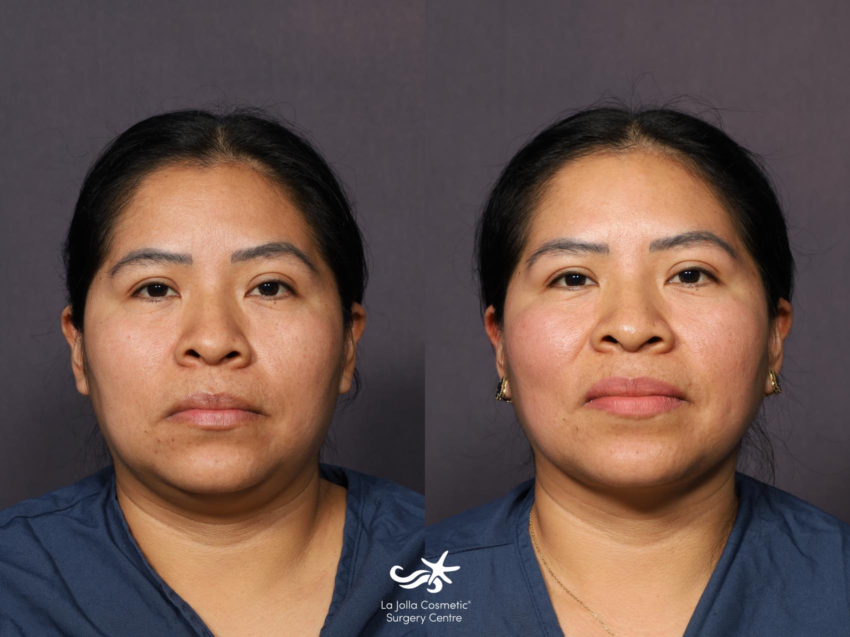 Before & After Neck Liposuction Result 1030 Front View in San Diego, CA