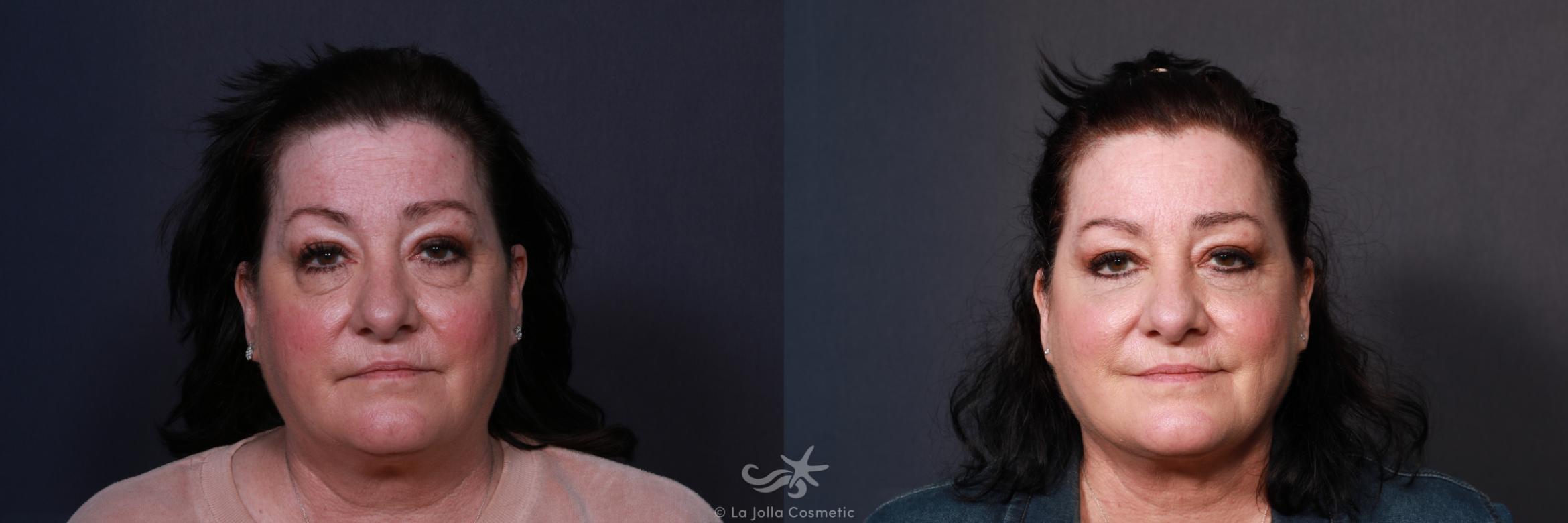 Before & After Neck Liposuction Result 595 Front View in San Diego, CA