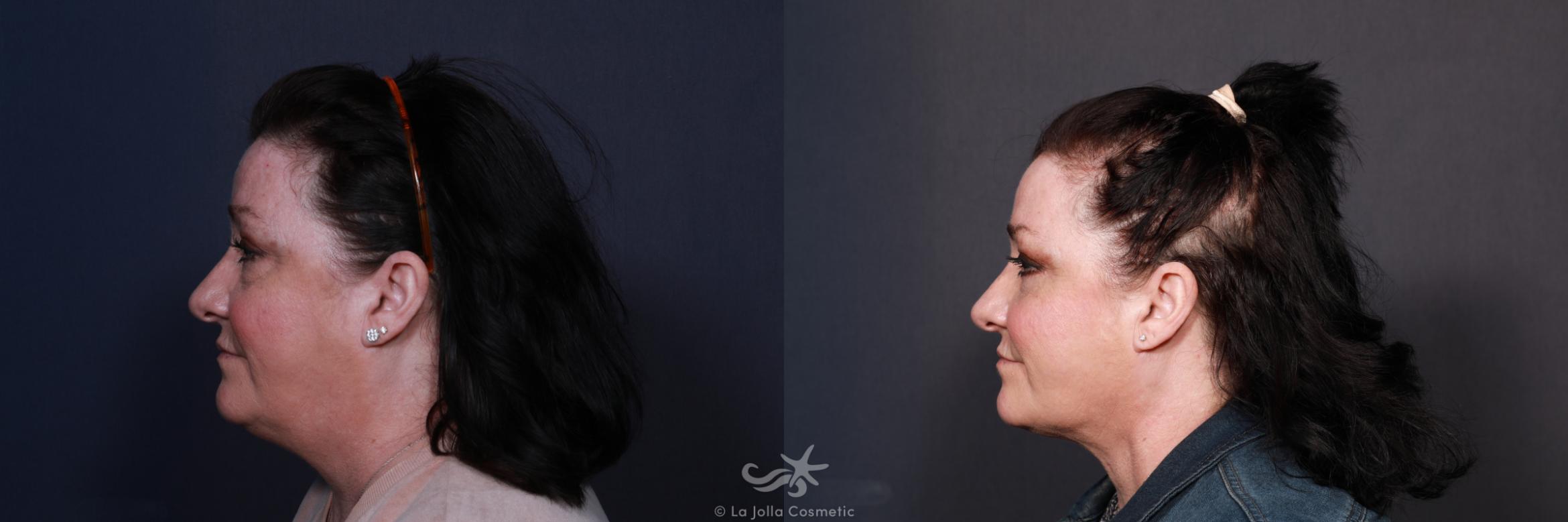 Before & After Neck Liposuction Result 595 Left Side View in San Diego, CA