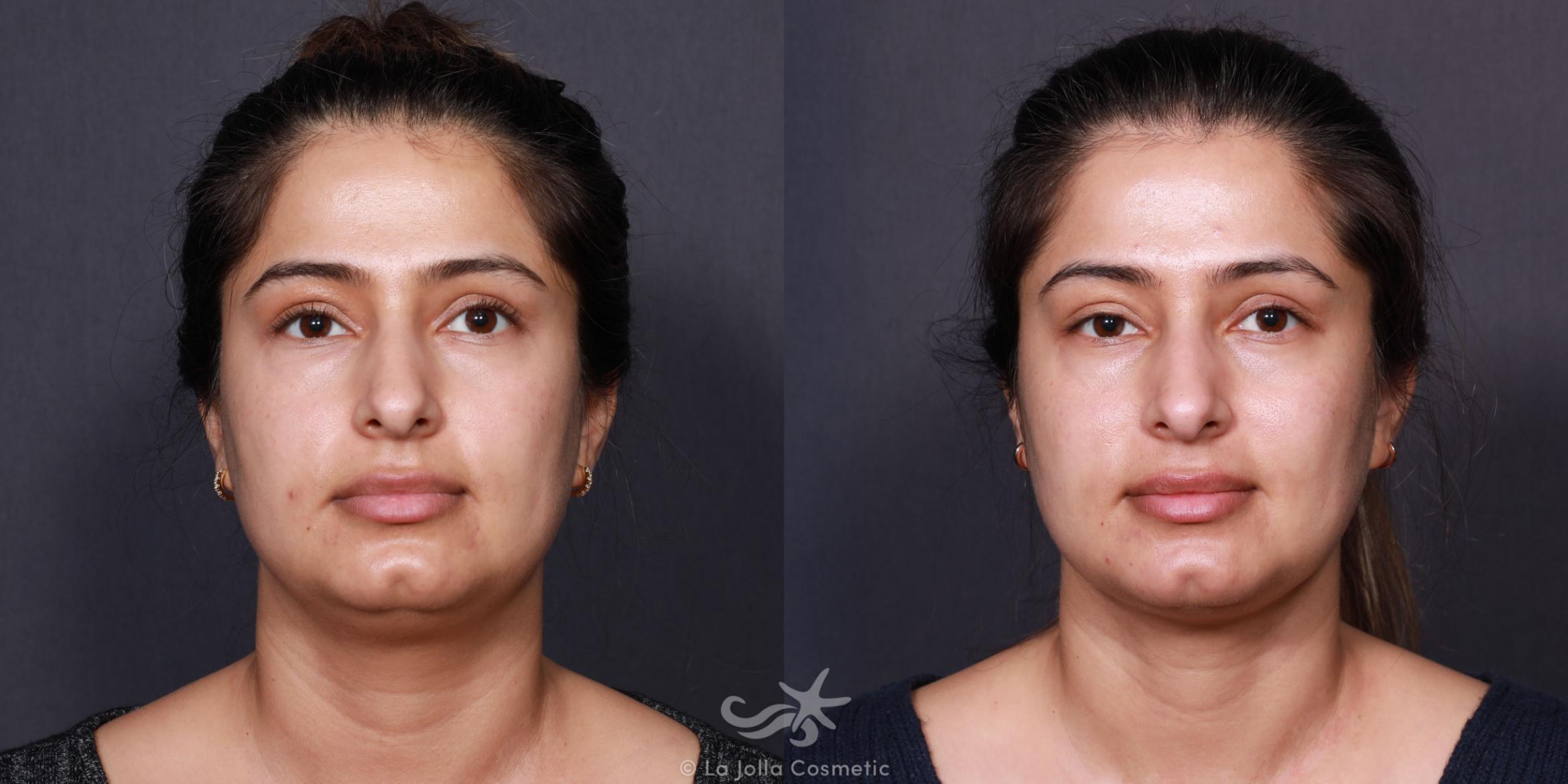Before & After Neck Liposuction Result 616 Front View in San Diego, CA
