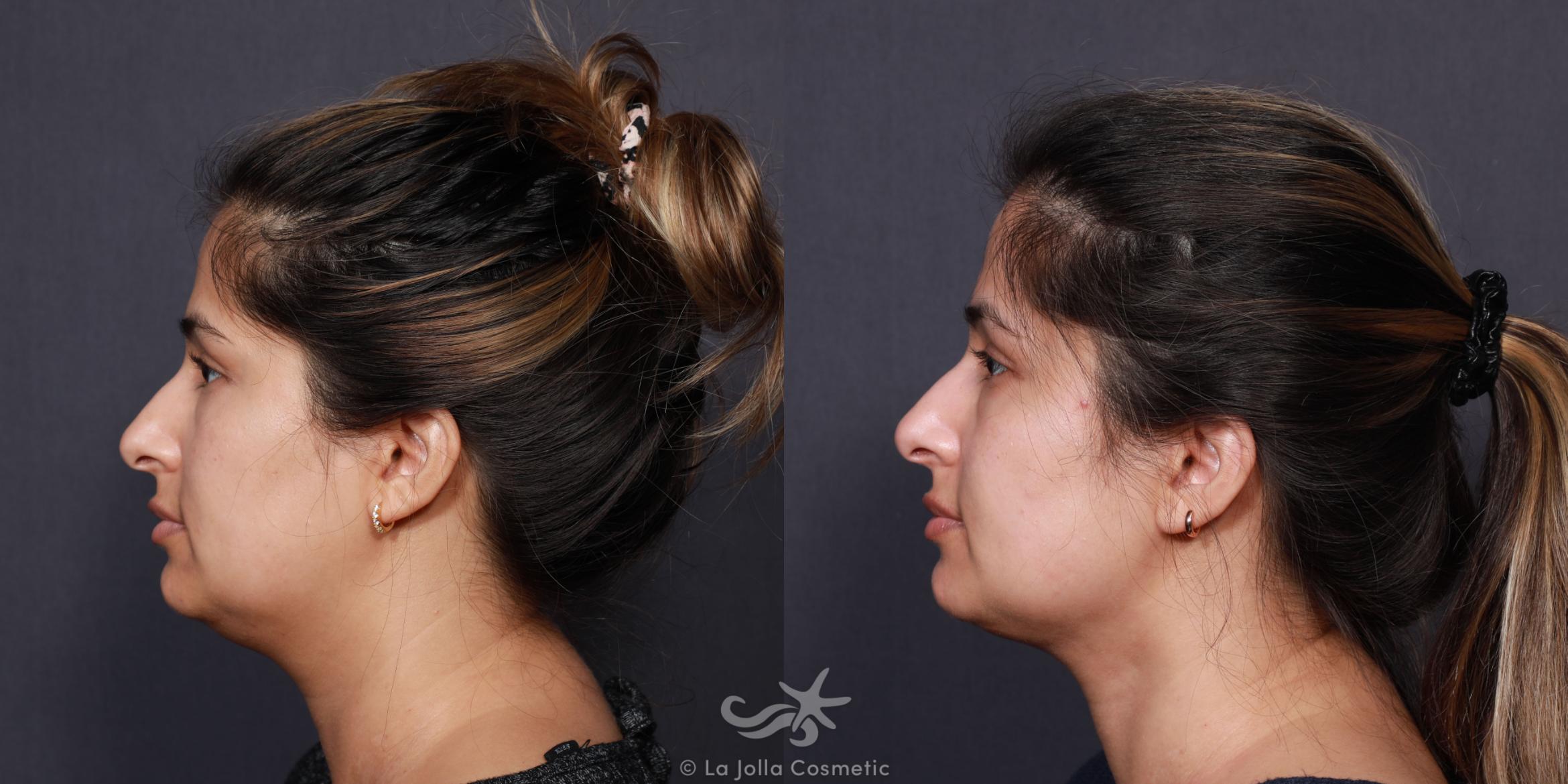 Before & After Neck Liposuction Result 616 Left Side View in San Diego, CA