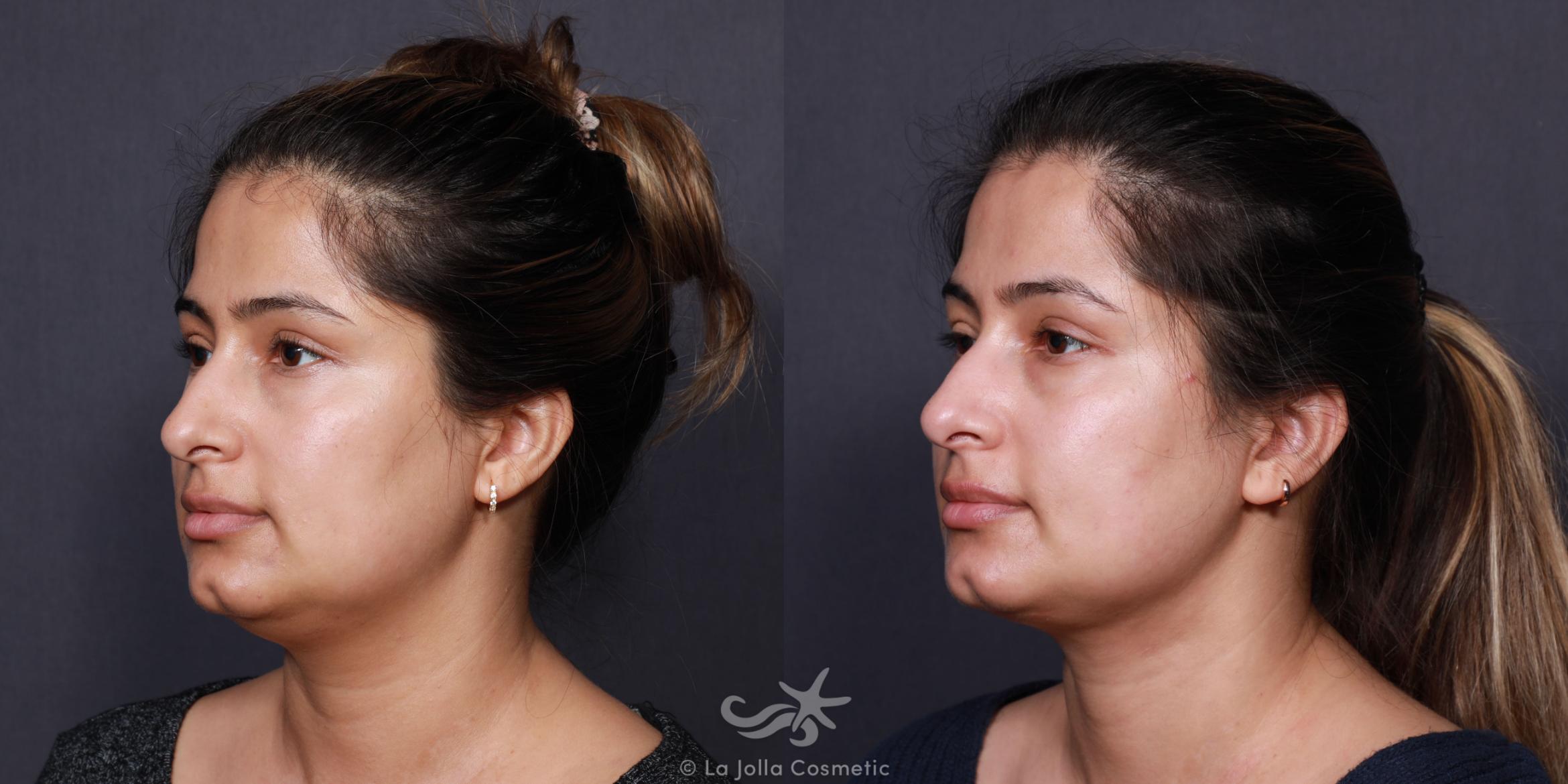 Before & After Neck Liposuction Result 616 Right Side View in San Diego, CA