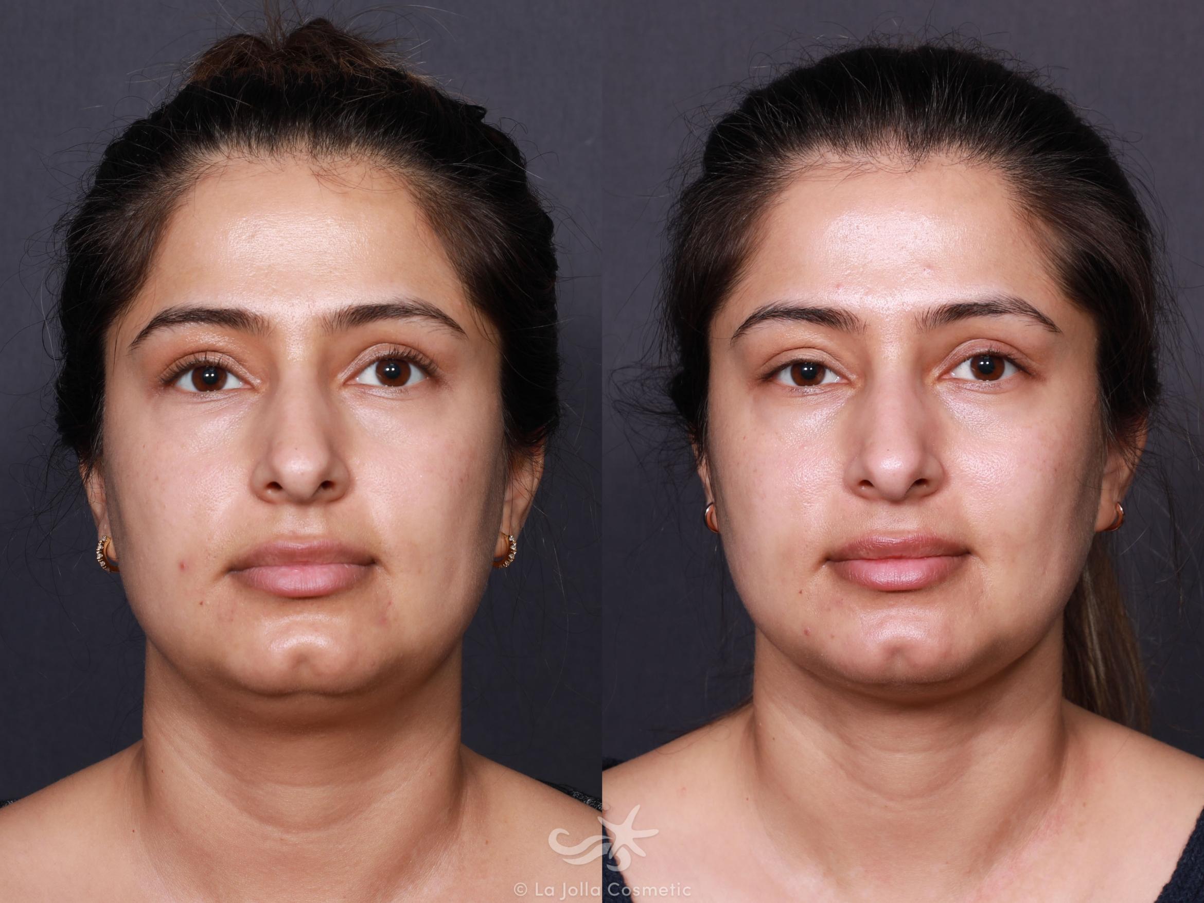 Before & After Neck Liposuction Result 630 Front View in San Diego, CA