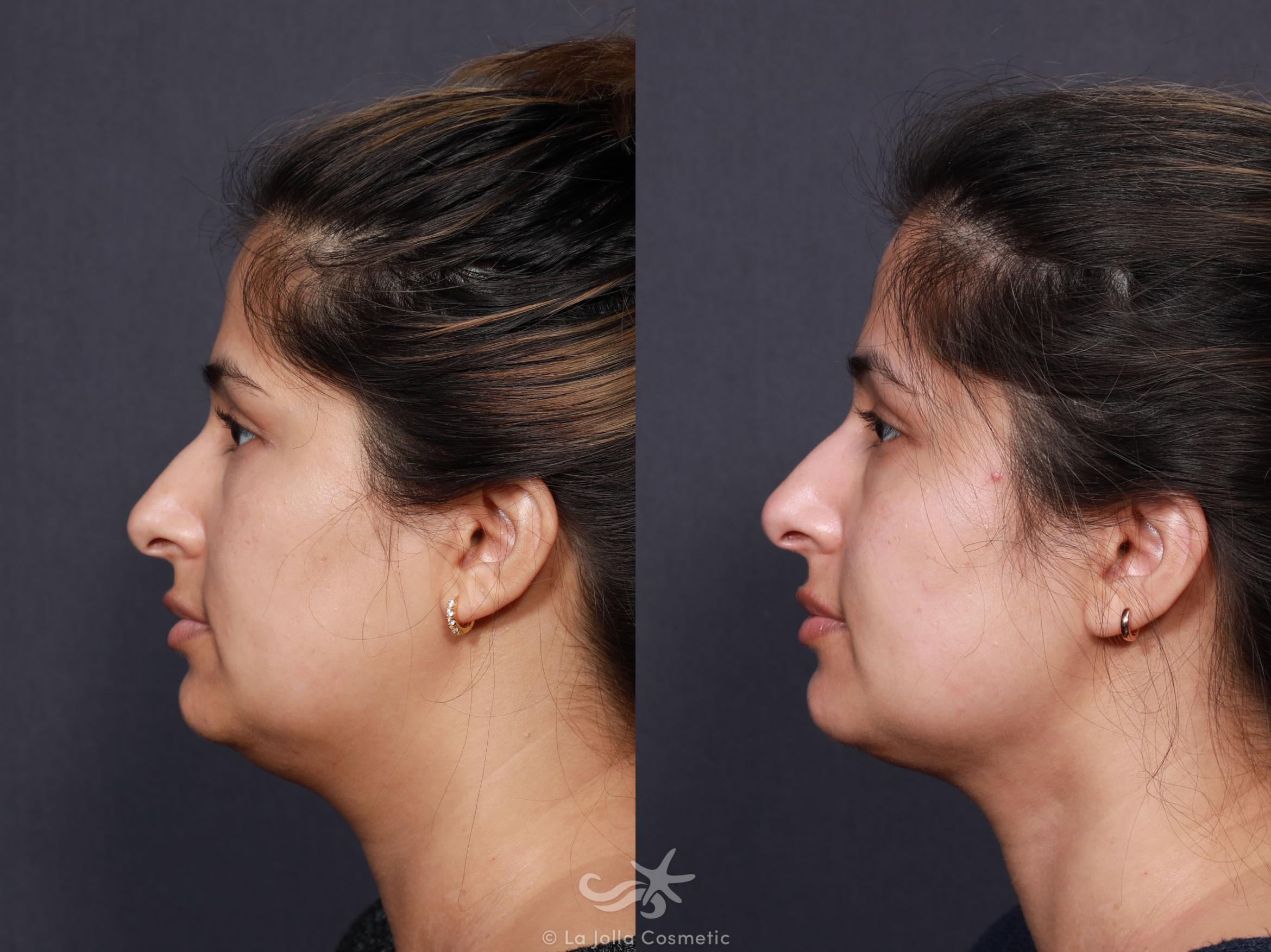 Before & After Neck Liposuction Result 630 Left Oblique View in San Diego, CA
