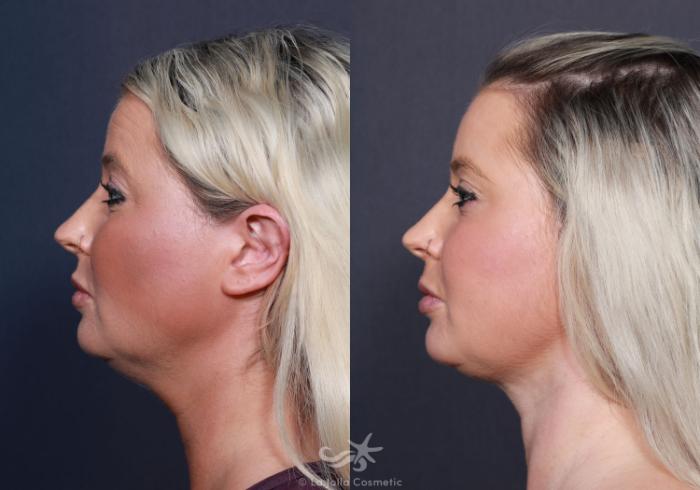 Before & After Neck Liposuction Result 632 Left Side View in San Diego, Carlsbad, CA