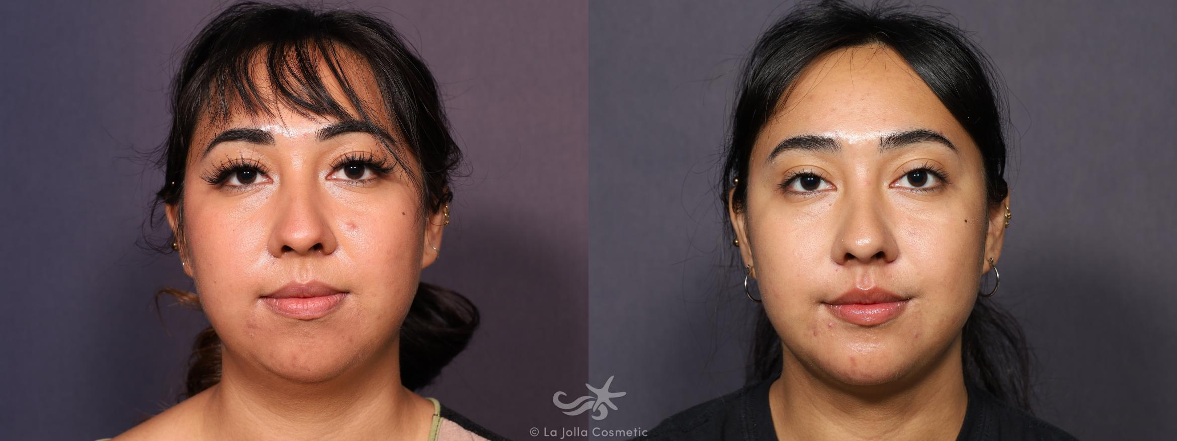 Before & After Neck Liposuction Result 715 Front View in San Diego, CA