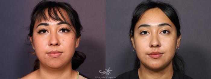 Before & After Neck Liposuction Result 715 Front View in San Diego, Carlsbad, CA