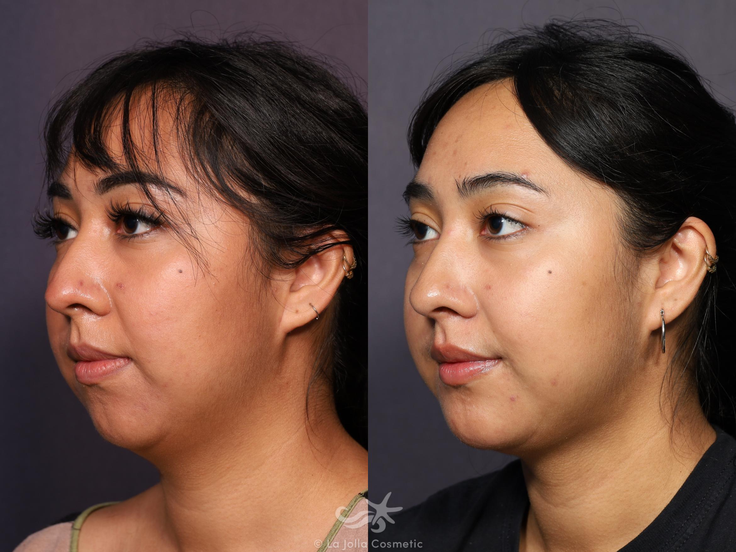 Before & After Neck Liposuction Result 715 Left Oblique View in San Diego, CA